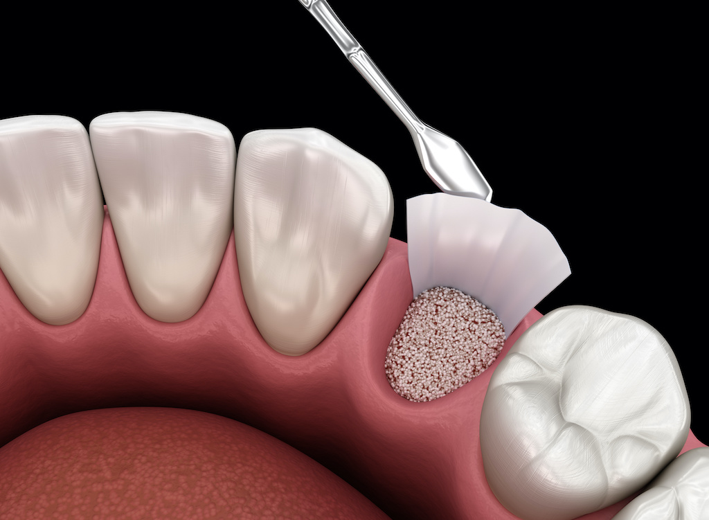 A bone graft example of how the procedure is done at Greenville Oral Surgery